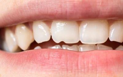 Is a Chipped Tooth a Dental Emergency? Find Out Here