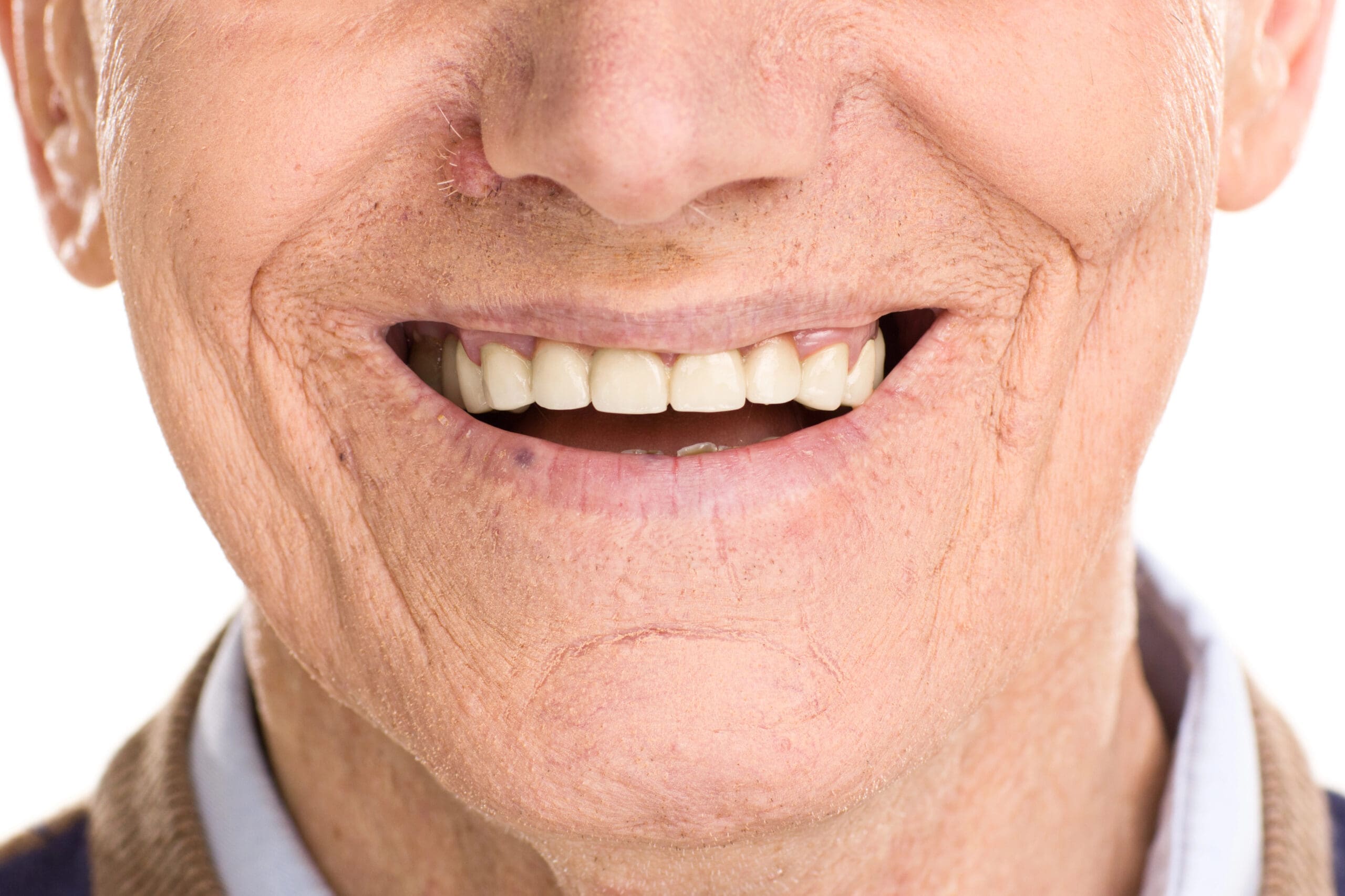 Close-up of an elderly man's smile with upper partial dentures, highlighting the natural look and secure fit of modern dental prosthetics. Learn more about upper partial dentures and their benefits.